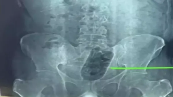 agra-yuvaak-ne-private-part-mein-bottle-ghused-li-doctors-surgery